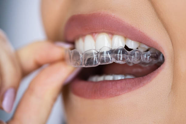 Get The Best Results With Invisalign Treatment